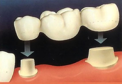 Puntea dentară